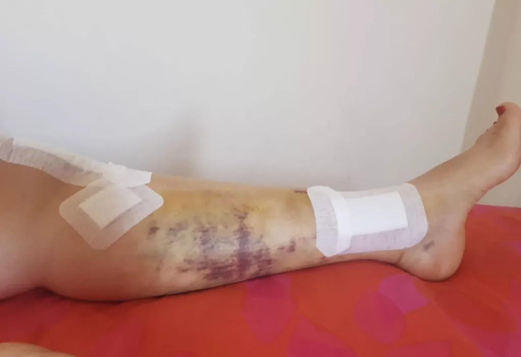 Pierna con hematoma y apósitos tras una intervención, en tratamiento de rehabilitación traumatológica
